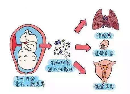 孕囊分隔的消失过程及其影响因素，深入了解孕期生理变化