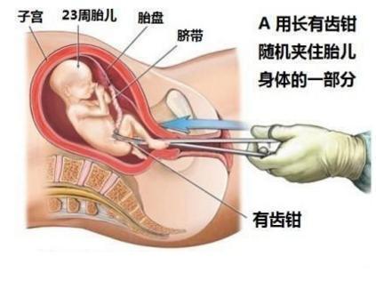 三个月妊娠期的人工流产，过程、注意事项与后续关怀