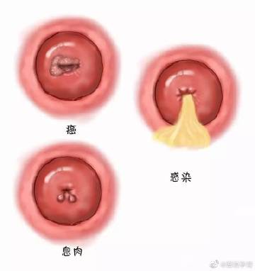 宫颈手术两个月后仍然出血的原因及应对措施